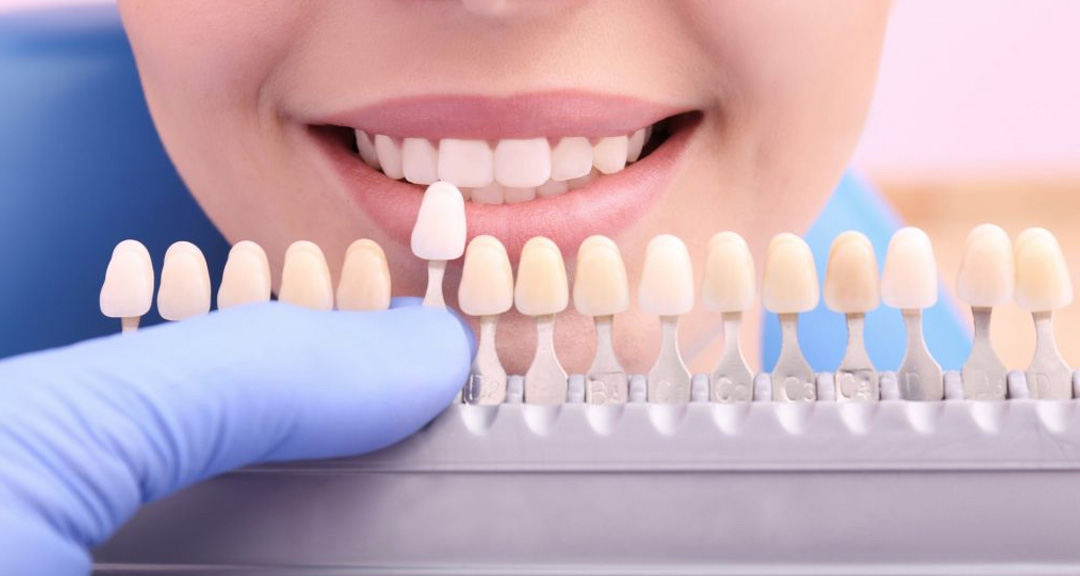Tooth-coloured dental fillings Ormeau patients can have in a single visit