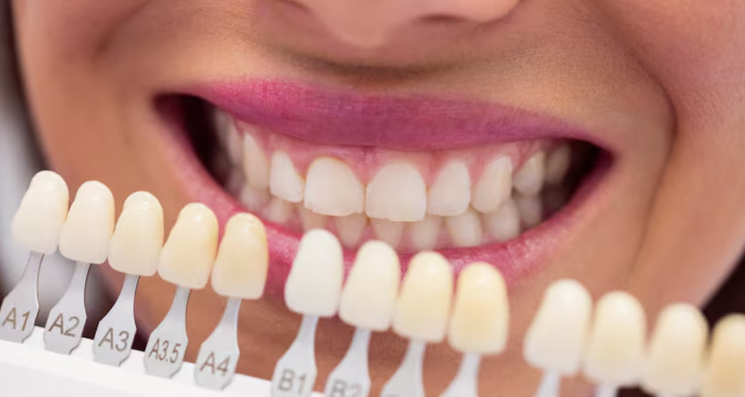 Close-up smile beside a tooth shade guide during teeth whitening Ormeau consultation